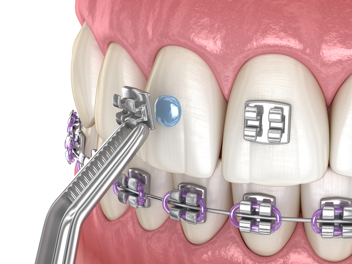 edgewise正畸，矫正牙齿的独特优势是什么？-图3