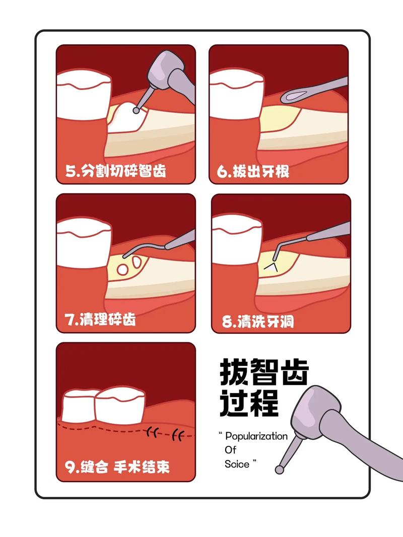 拔牙新技术,如何让拔牙更轻松、恢复更快?-图3 拔牙新技术,如何让拔牙更轻松、恢复更快?-图3