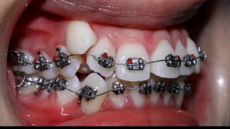 第一次正畸戴牙套，疼不疼？怎么缓解最有效？-图2