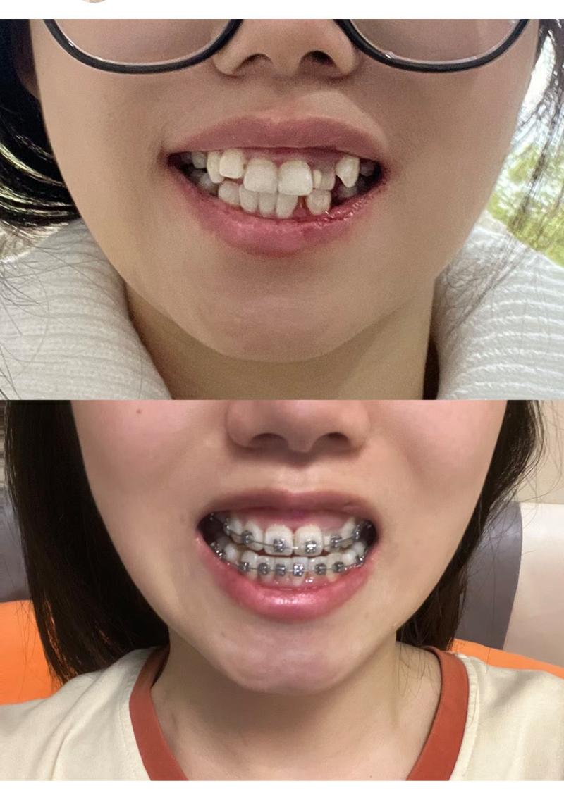 门牙一前一后正畸图片能看出哪些矫正效果？-图2