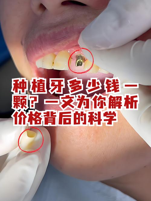 种牙坏了还能种吗-图1