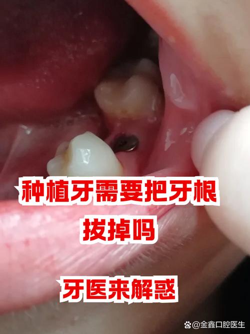 种牙坏了还能种吗-图2