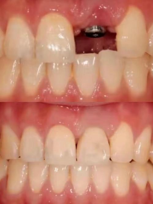 拔牙后一年种牙合适吗？最佳时机怎么判断？-图3