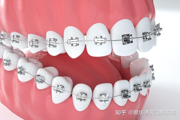 正畸治疗中圆丝和方丝的使用顺序是怎样的？-图3