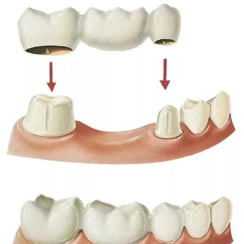 快速镶牙的方法可靠吗？效果和安全性如何？-图3