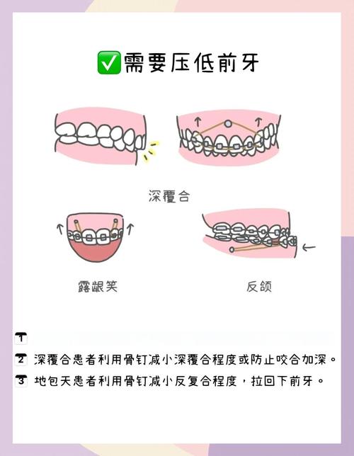 压低大牙的方法有哪些？效果和注意事项如何？-图2