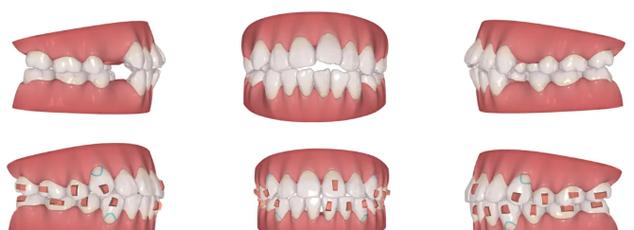正畸前智齿一定要拔？关键看这几点-图2