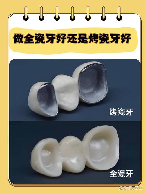 做烤瓷牙好还是正畸好-图1 做烤瓷牙好还是正畸好-图1