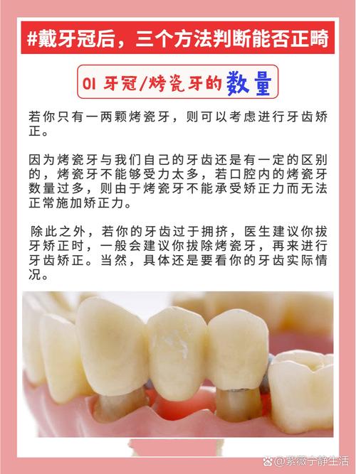 做烤瓷牙好还是正畸好-图3 做烤瓷牙好还是正畸好-图3