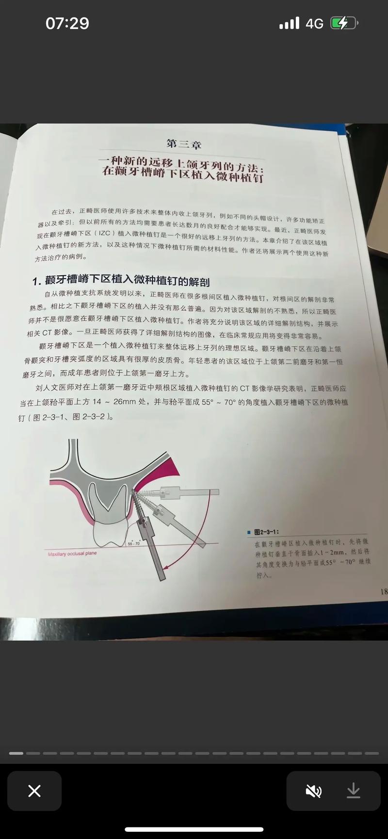 正畸支抗钉方法-图1 正畸支抗钉方法-图1