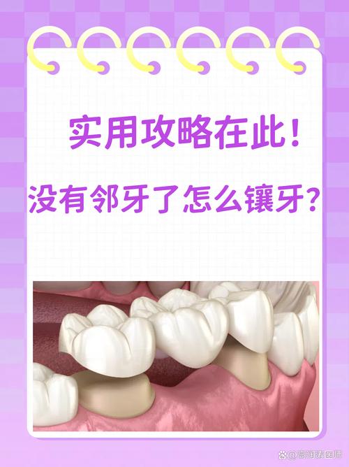 长沙镶牙的方法有哪些？各自特点是什么？-图1