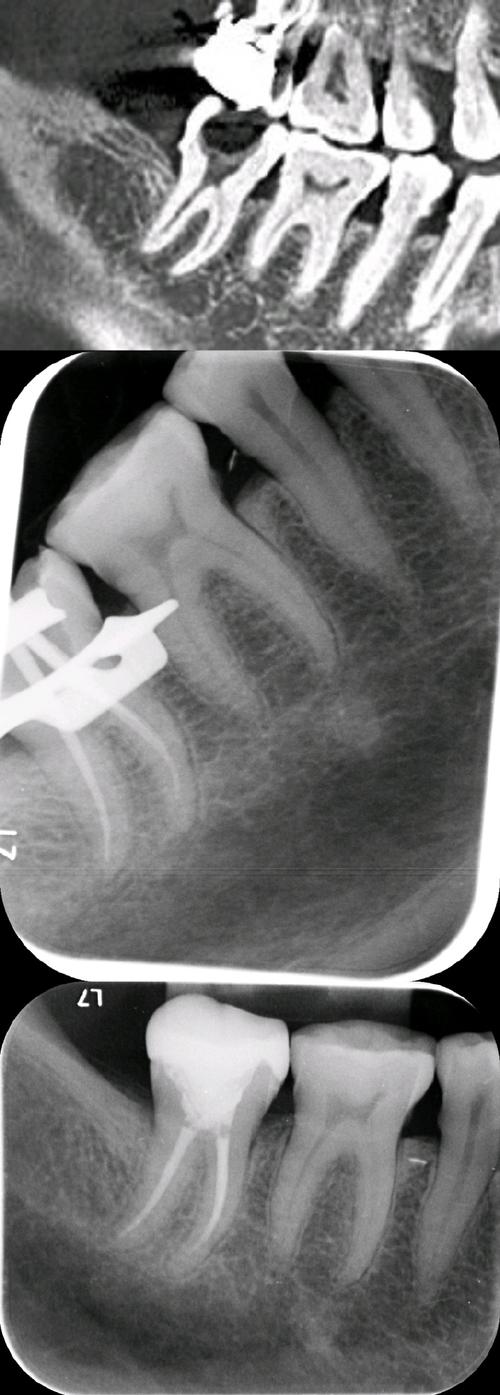 正畸过程中为何会出现急性牙髓炎?-图3 正畸过程中为何会出现急性牙髓炎?-图3