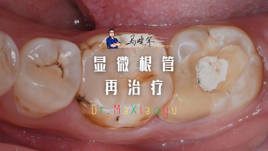 根管内牙胶尖取出困难有哪些有效解决方法？-图2