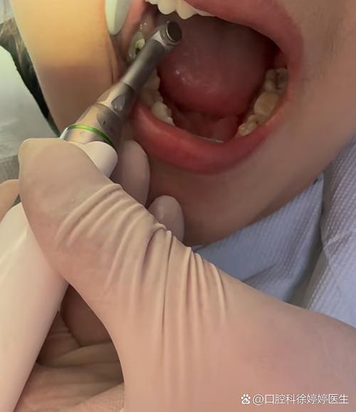 根管内牙胶尖取出困难有哪些有效解决方法？-图3