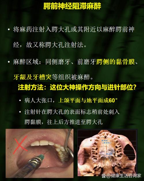 牙周膜麻醉方法-图1