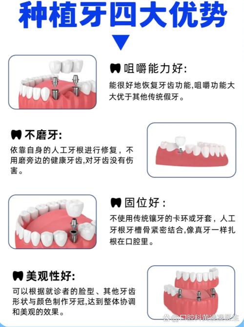 种牙和植牙是一回事吗?两者到底有啥区别?-图2 种牙和植牙是一回事吗?两者到底有啥区别?-图2