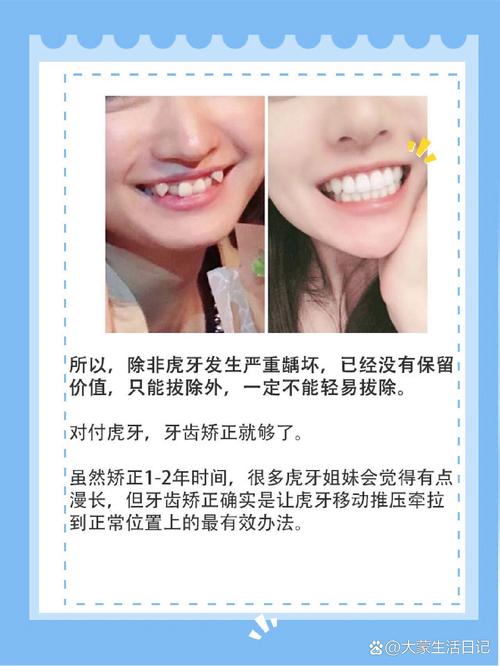 虎牙矫正方法有哪些?如何选对适合自己的?-图1 虎牙矫正方法有哪些?如何选对适合自己的?-图1