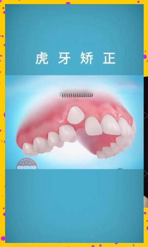 虎牙矫正方法有哪些?如何选对适合自己的?-图2 虎牙矫正方法有哪些?如何选对适合自己的?-图2