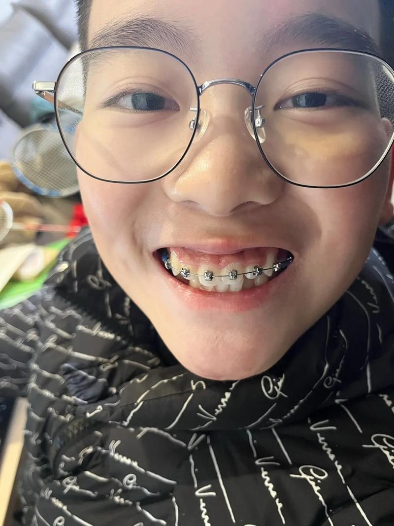 虎牙矫正方法有哪些?如何选对适合自己的?-图3 虎牙矫正方法有哪些?如何选对适合自己的?-图3