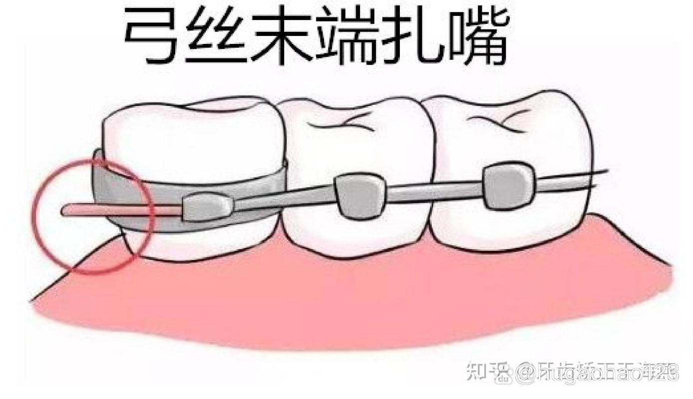 矫正蜡的正确使用方法有哪些步骤？-图3