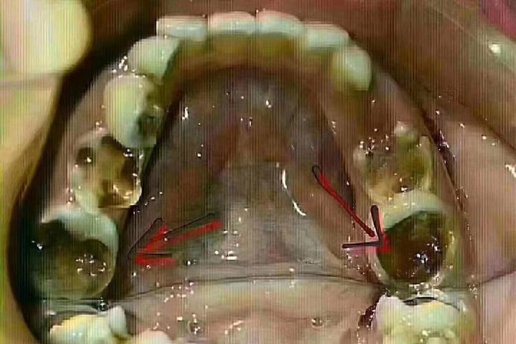 六龄齿没有了能正畸吗-图2