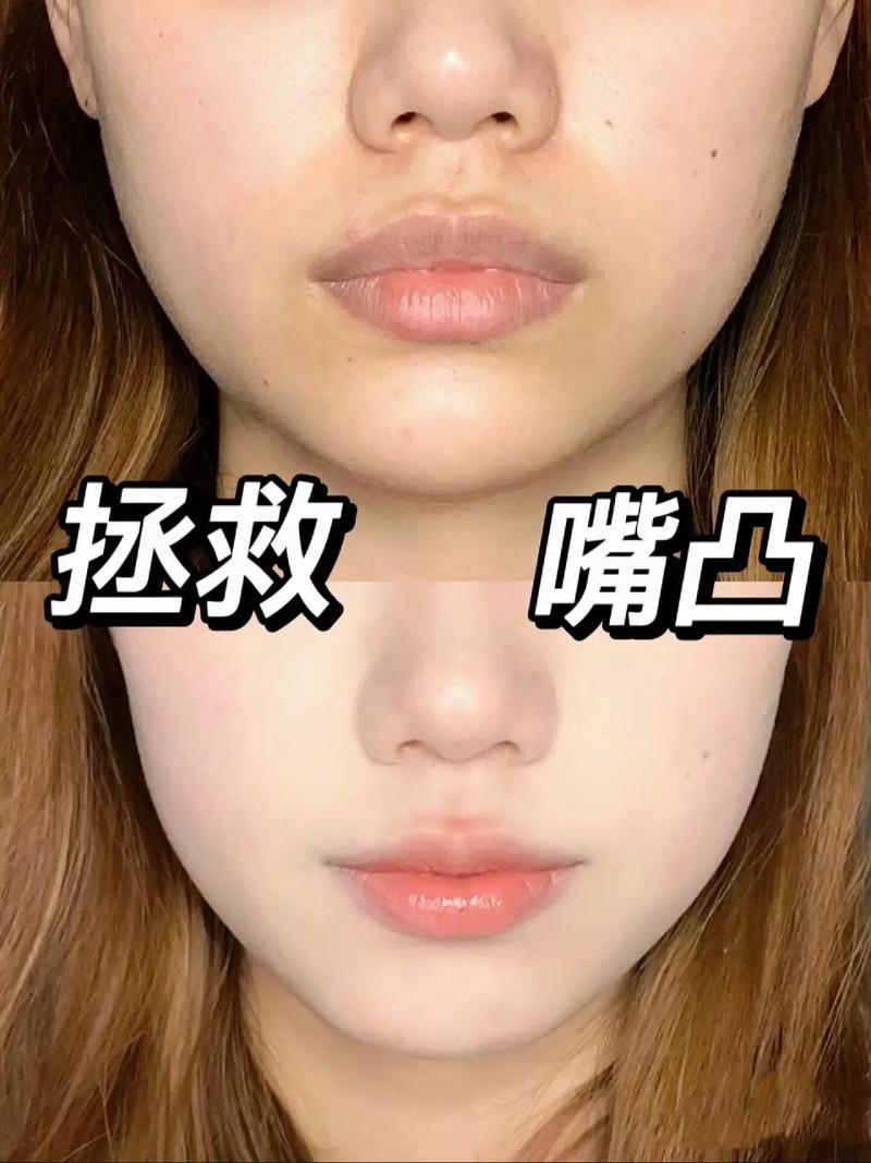 突嘴治疗方法有哪些？哪种更适合改善？-图2