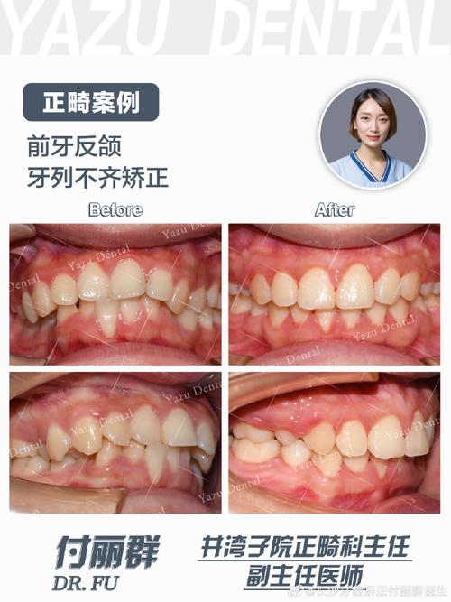 正颌之前，是否一定要先做正畸治疗？-图3
