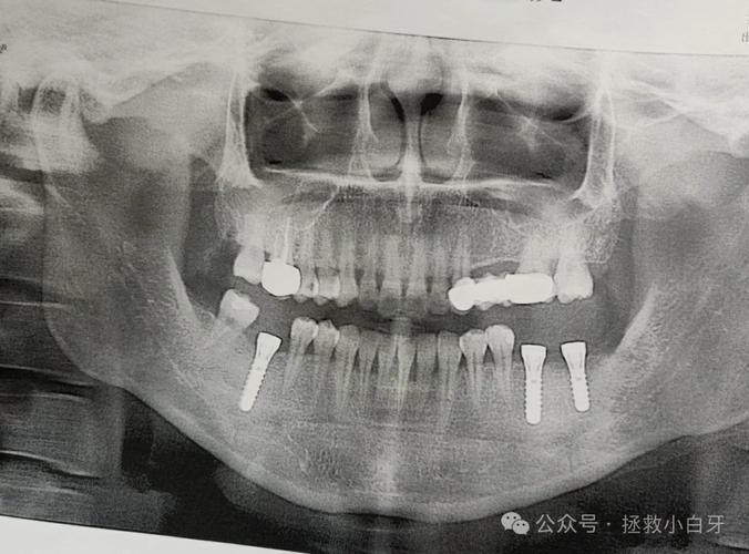 牙槽骨萎缩 种牙-图2