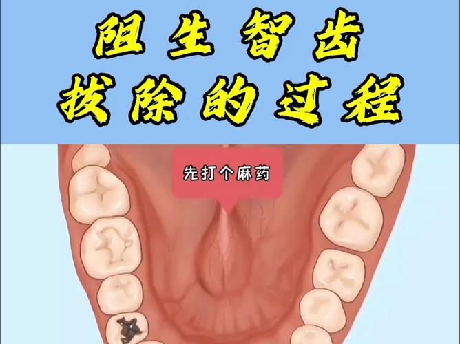 阻生牙拔出方法-图3