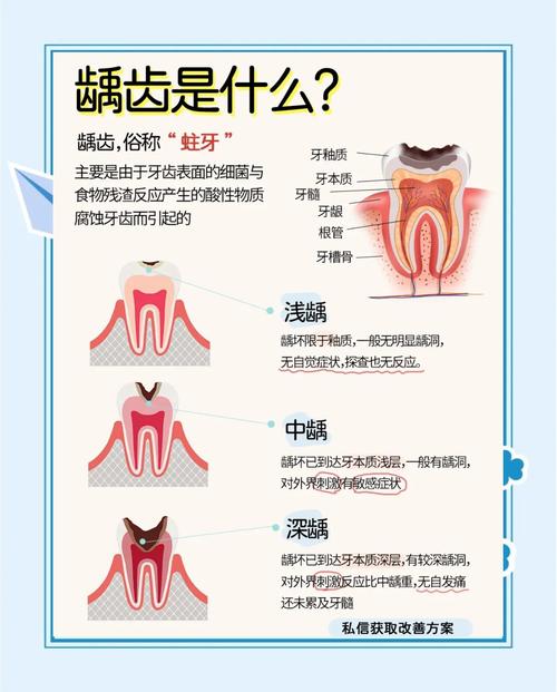 龋齿的表示方法-图1