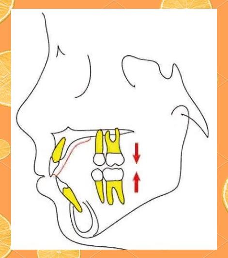 牙齿压低的方法-图2