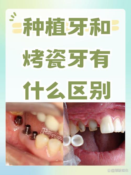 种牙 镶牙的区别-图3