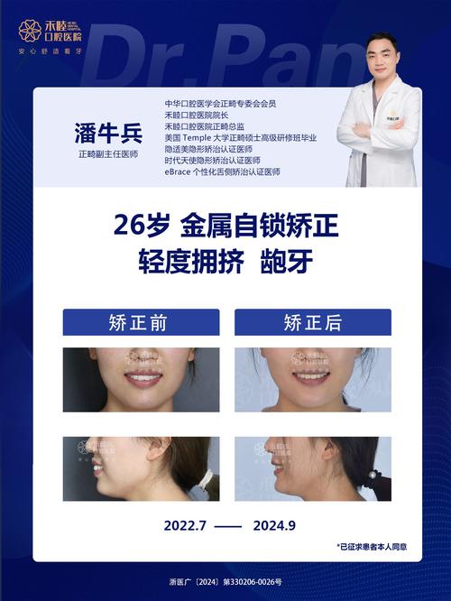 龅牙的治疗方法有哪些?哪种最有效且安全?-图1 龅牙的治疗方法有哪些?哪种最有效且安全?-图1