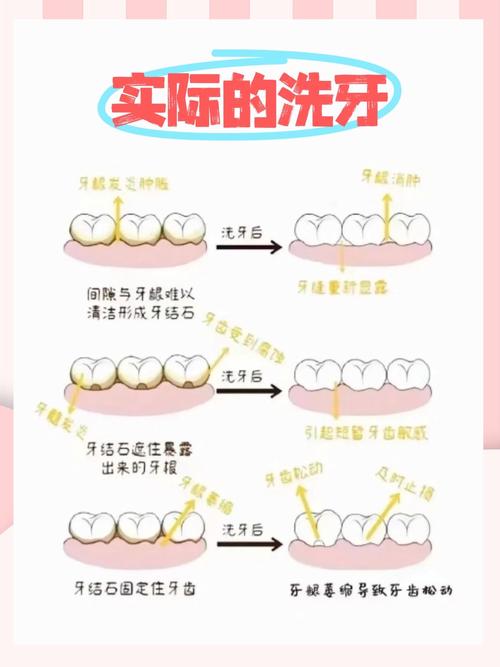 洗牙方法这么多,哪种才最适合自己呢?-图3 洗牙方法这么多,哪种才最适合自己呢?-图3