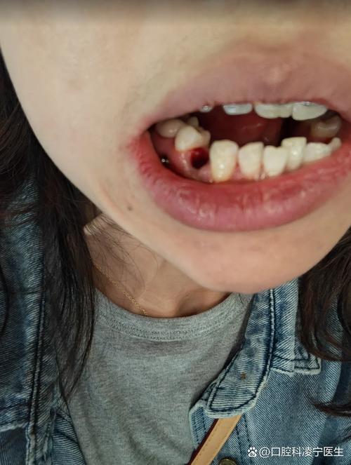 拔牙不种牙的后果-图3