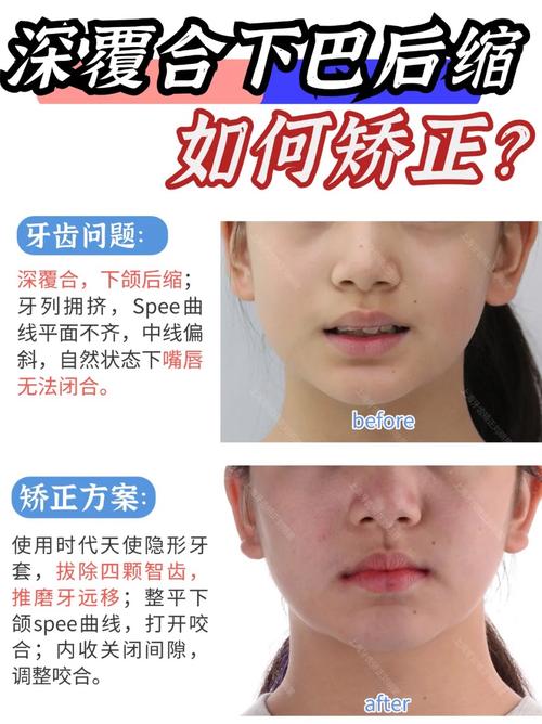 正畸提升牙齿的后遗症-图3