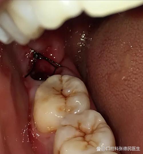 种牙一期后怀孕了-图3