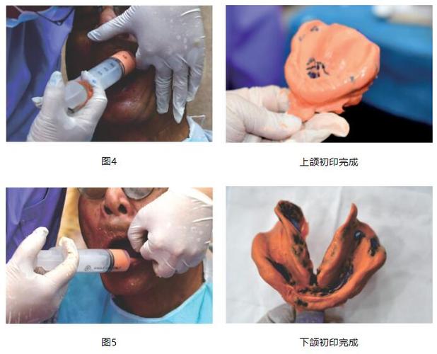 制取印模的方法有哪些？-图2