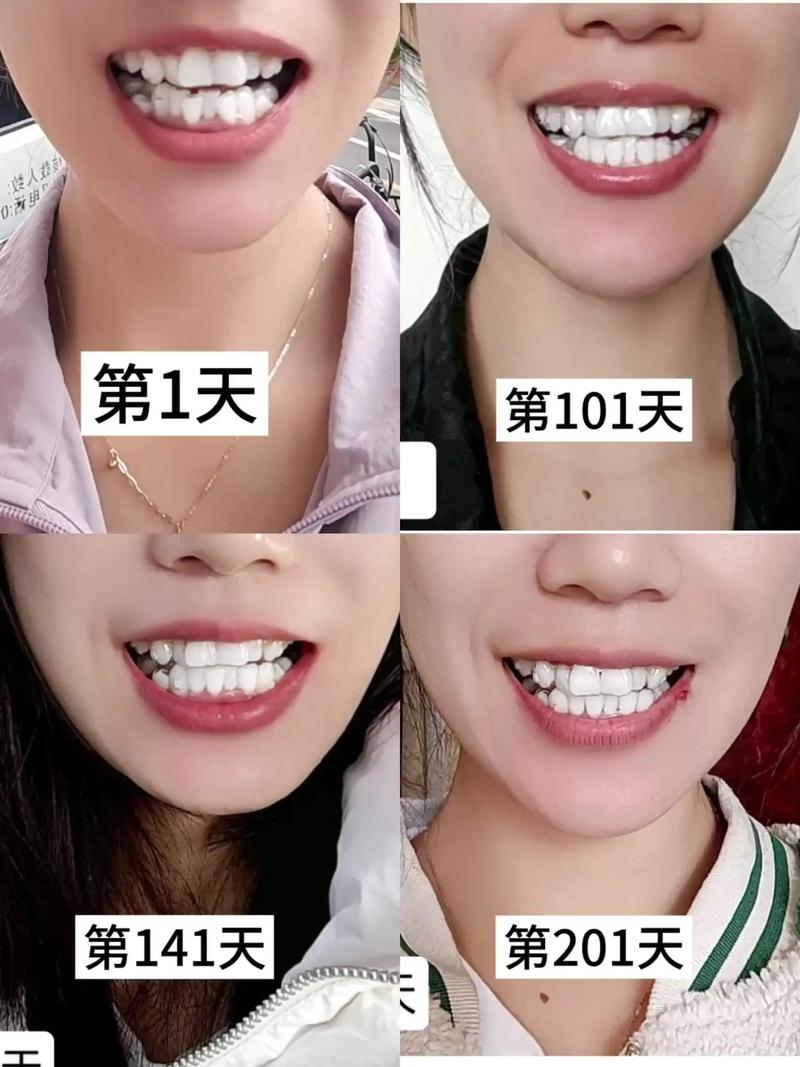 正畸牙多久能看出效果-图1
