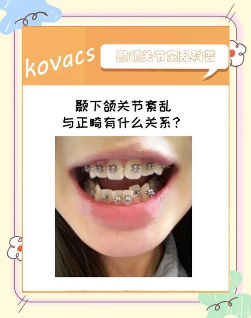 正畸后颞下颌关节紊乱-图3 正畸后颞下颌关节紊乱-图3