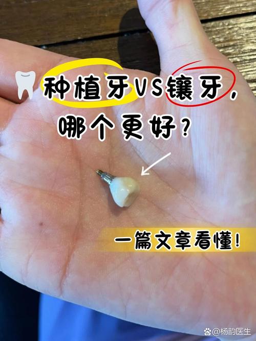 镶牙与种牙哪个好-图2 镶牙与种牙哪个好-图2