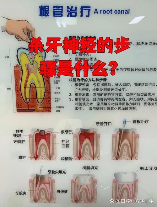 杀牙神经的方法-图1 杀牙神经的方法-图1