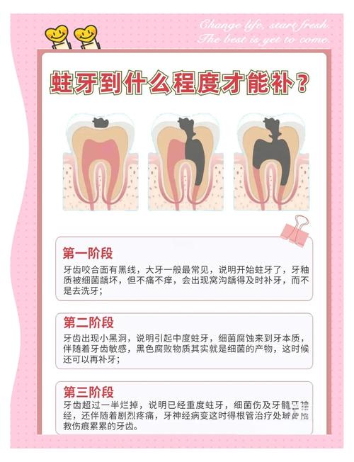 龋齿在治疗方法-图3