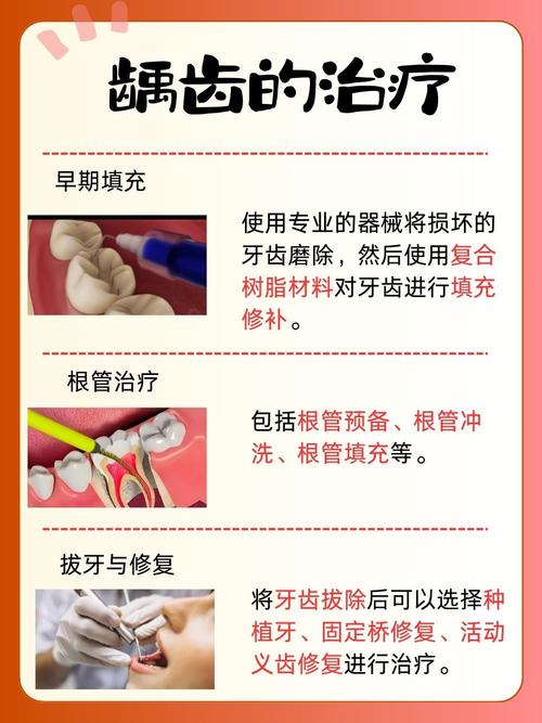 龋齿在治疗方法-图2