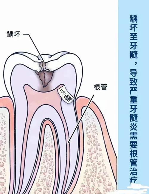根管钉使用方法-图1