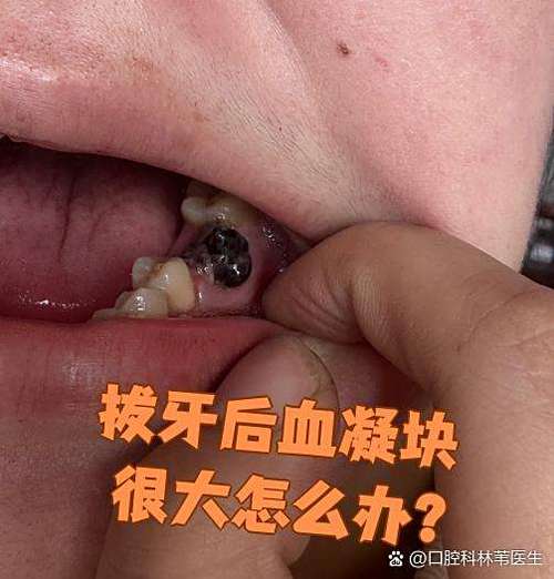 拔牙后止血方法-图3