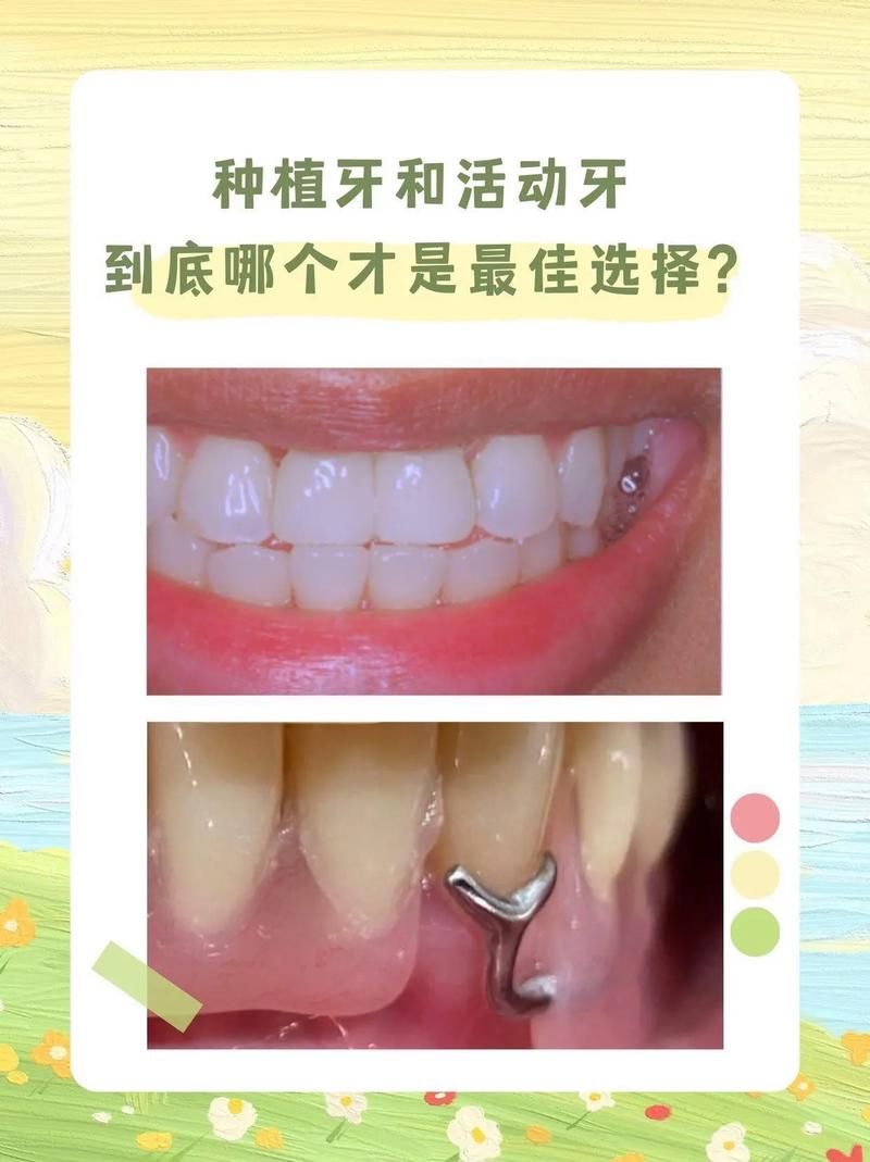 种牙好还是牙套好-图3