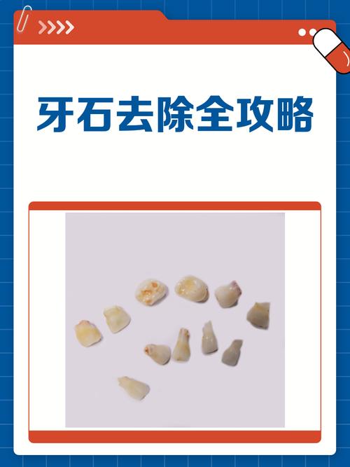 去除牙石的方法-图3 去除牙石的方法-图3