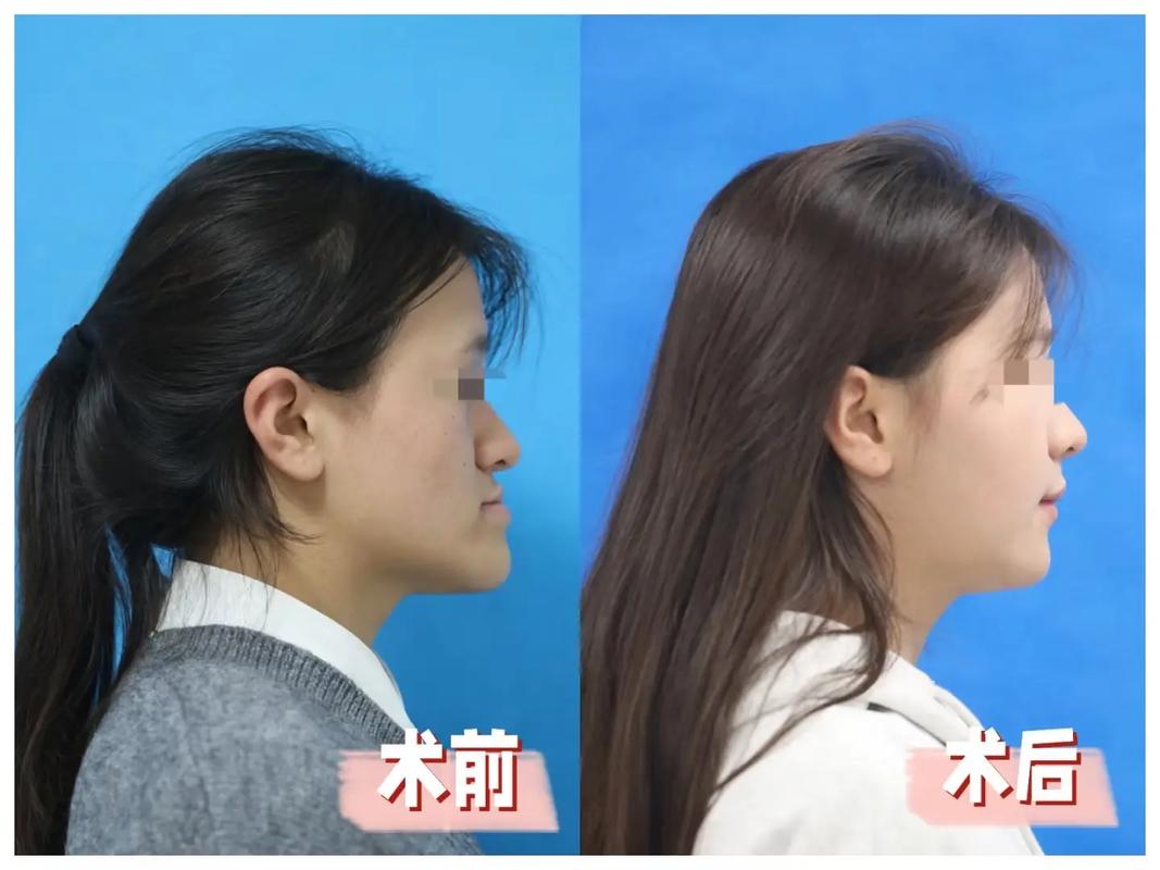 骨性地包天能否通过正畸治疗有效矫正?-图1 骨性地包天能否通过正畸治疗有效矫正?-图1