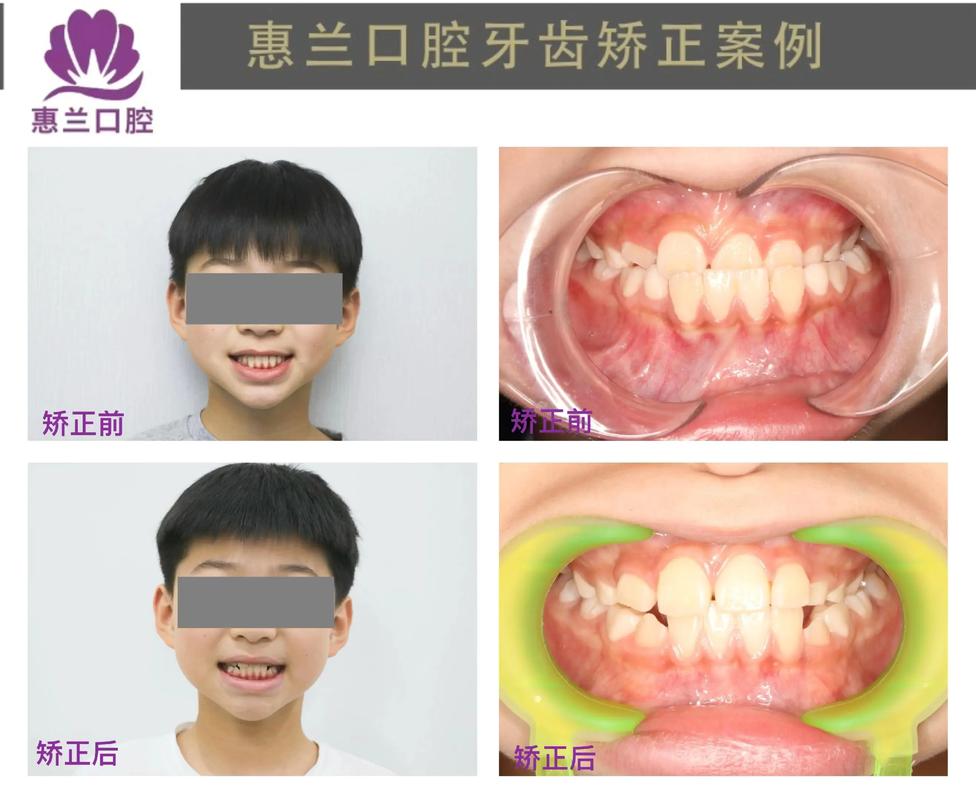 骨性地包天能否通过正畸治疗有效矫正?-图3 骨性地包天能否通过正畸治疗有效矫正?-图3